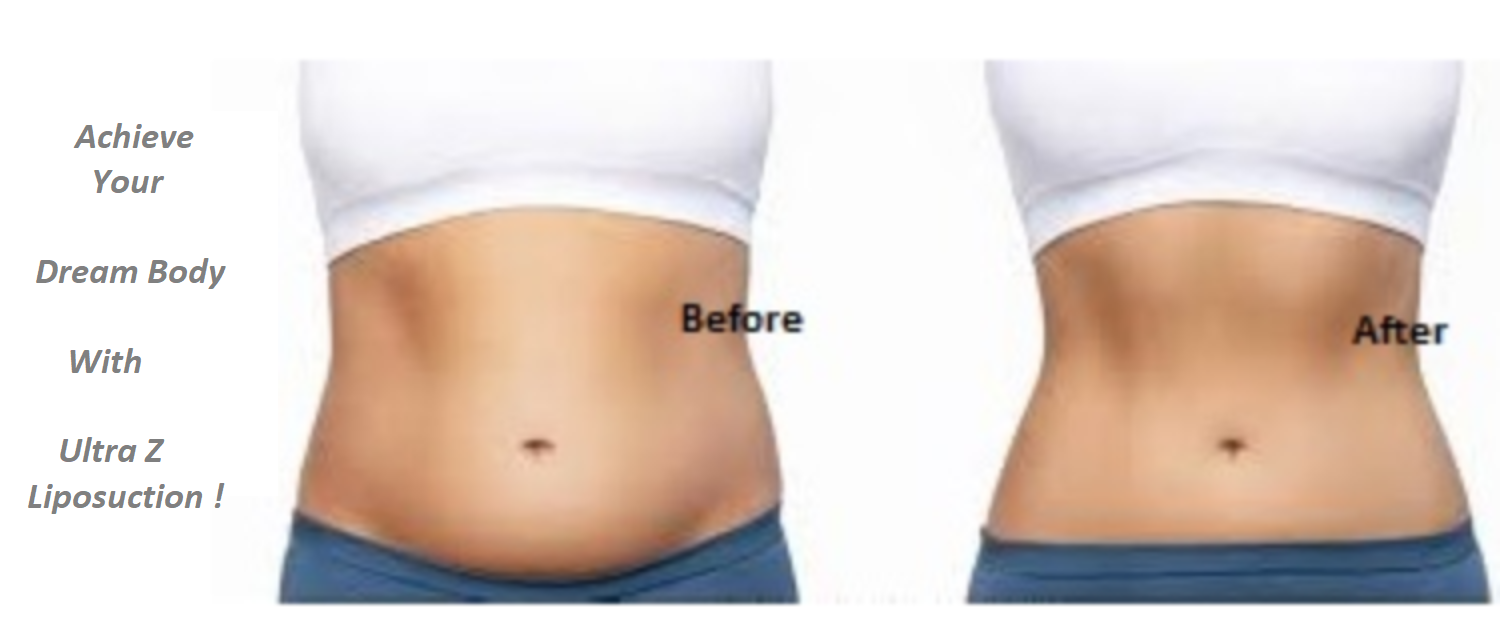 Ultrasound Liposuction surgery cost India