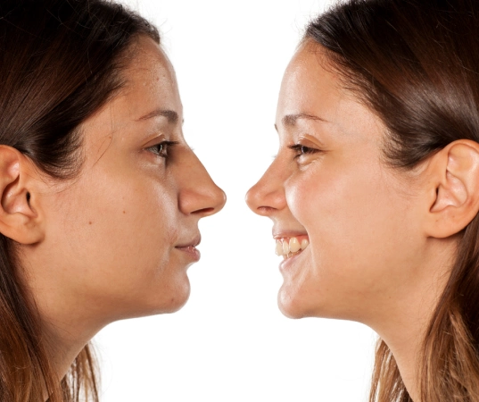 Rhinoplasty