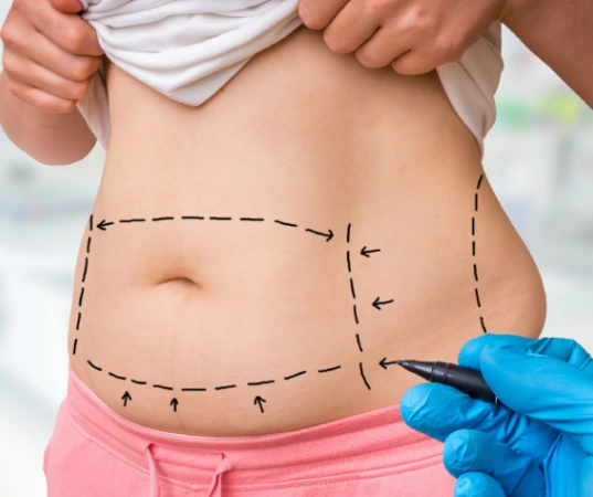 Liposuction