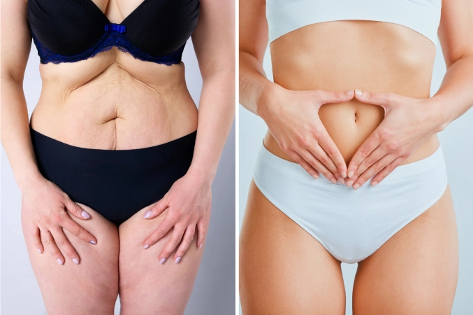 Tummy Tuck