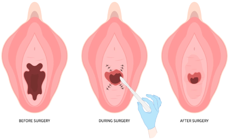 Labiaplasty during surgery