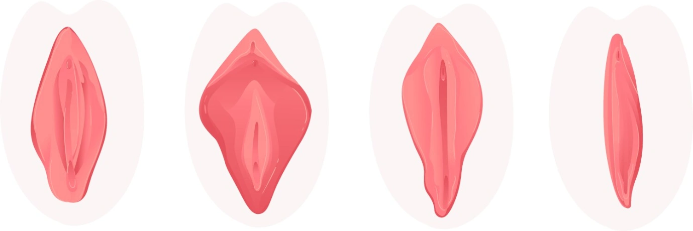 Labiaplasty before and after
